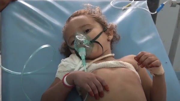 طفلة تعرضت لرصاصة قناص حوثي في مدينة حيس باليمن
